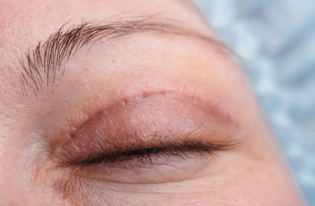 Blefaroplastia del párpado superior. Una operación que elimina el exceso de piel fea de los párpados por encima de los ojos. La foto muestra que ya se han quitado las costuras. La cicatriz sana. Este es el