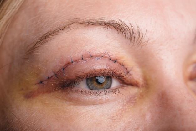 Foto blefaroplastia del párpado superior. una operación que elimina el exceso de piel fea de los párpados por encima de los ojos. las fotos muestran costuras. este es el tercer día después de la operación.
