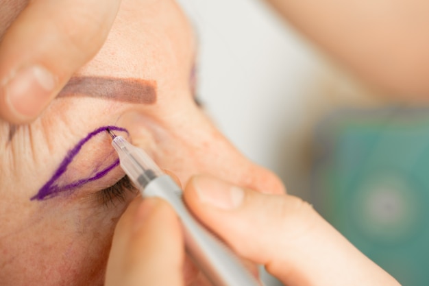 Blepharoplastik Markup Nahaufnahme auf dem Gesicht vor der plastischen Chirurgie Operation zur Veränderung der Augenregion des Gesichts in der medizinischen Klinik. Doktor, der plastische kosmetische Operation tut