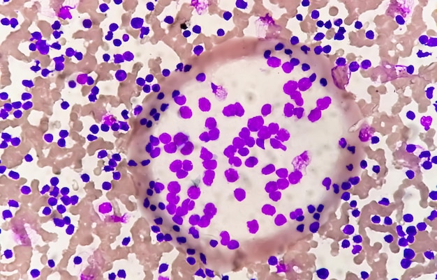 Blutausstrich unter dem Mikroskop, der chronische lymphoblastische Leukämie (CLL) zeigt