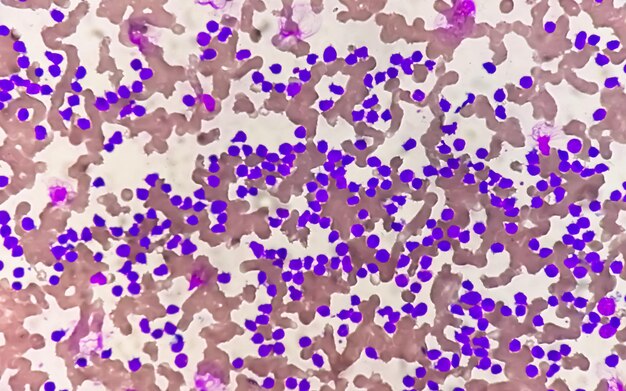 Blutausstrich unter dem Mikroskop, der chronische lymphoblastische Leukämie (CLL) zeigt