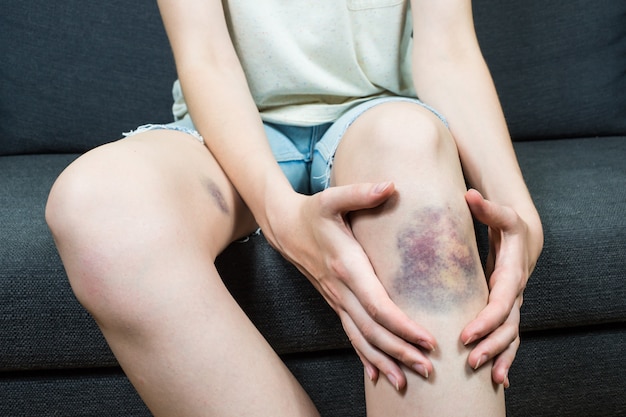 Bluterguss am jungen weiblichen Knie