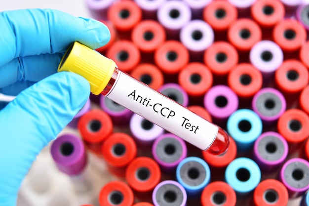 Foto blutprobe für die anti-ccp-testdiagnose bei rheumatoider arthritis