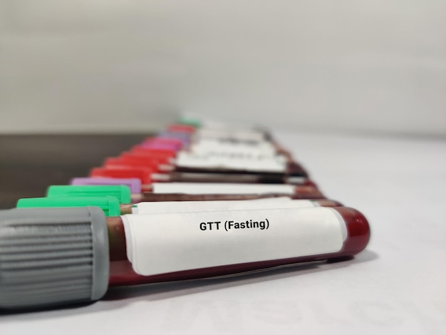 Blutprobe für Glukosetoleranztest Nüchtern GTT Diagnose einer Hyperglykämie oder Hypoglykämie
