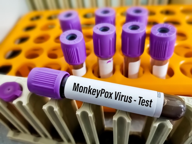 Foto blutprobe für monkeypox-virustest