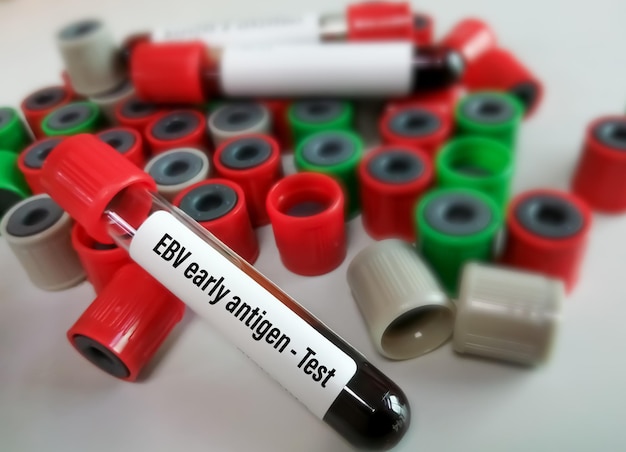 Blutprobe isoliert für EBV-Antigen-Frühtest.