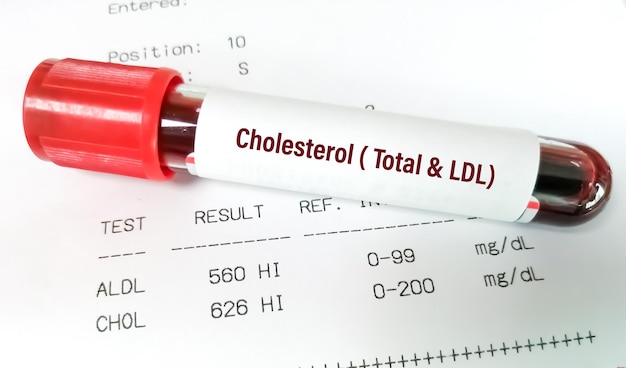 Blutprobe mit abnormal hohem Bericht über Gesamtcholesterin und LDL-Cholesterintest