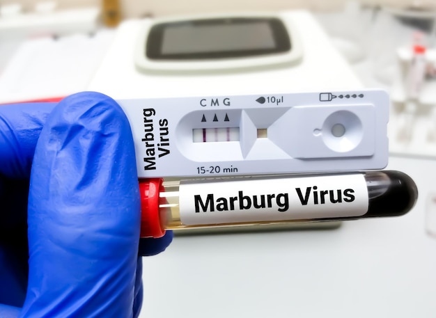 Blutprobe und Schnelltestkassette für Marburg-Virustest, Medizin- und Gesundheitskonzept