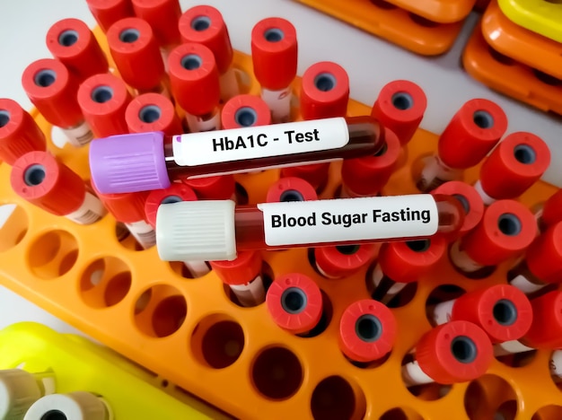 Blutproben für HbA1C- und Blutzuckertest zur Diagnose und Überwachung von Diabetes-Erkrankungen