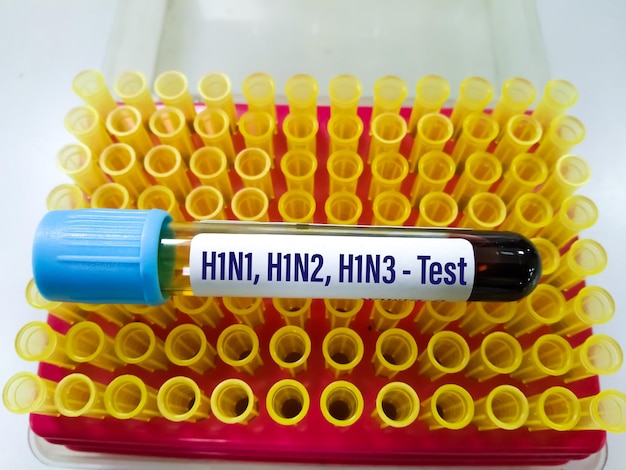 Blutproben für Influenza-A-, B-Virus und Subtyp H1N1, H1N2 und H1N3-Test im medizinischen Labor