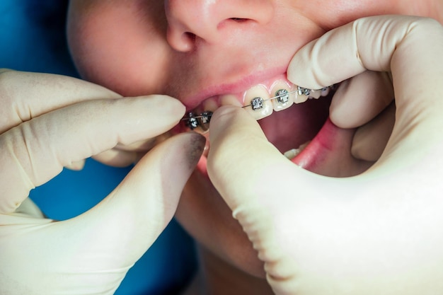 boca abierta dental femenina con aparatos ortopédicos de gel fijador en la recepción. Sistema de soporte kappa de cerca.