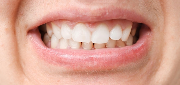 Boca com dentes brancos maloclusão problema de saúde closeup oclusão desalinhamento