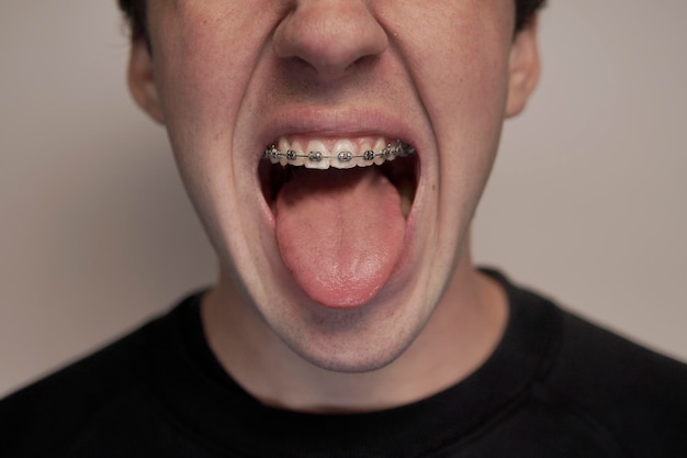 boca de menino com aparelhos de metal saindo de sua língua