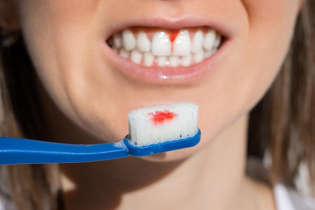 Boca de mujer con encías sangrantes durante el cepillado de los dientes Enfermedad periodontal avitaminosis o gingivitis