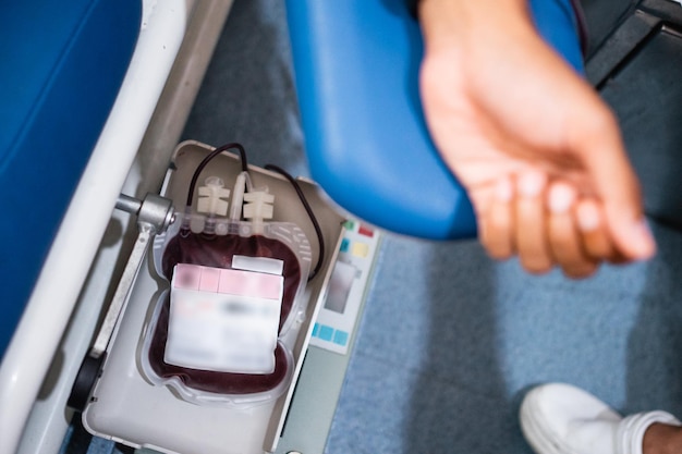 Bolsas de sangre tiradas en el estante debajo de la mano donde el paciente recibió una transfusión de sangre