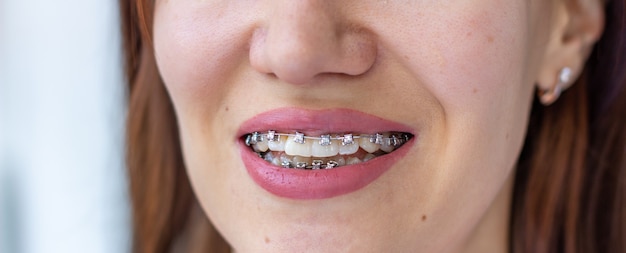 Brustkorbsystem im lächelnden Mund eines Mädchens, Makrofotografie der Zähne, Nahaufnahme der Lippen