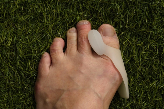 Bunion regulador de silicona bunion en el pie izquierdo de una mujer blanca adulta en astro turf