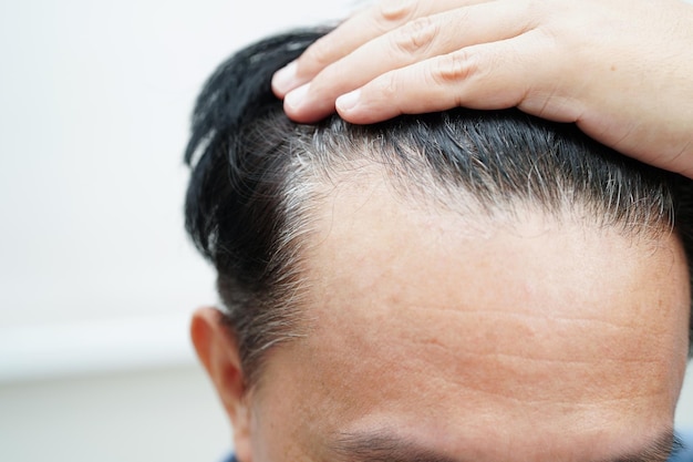 Cabeça careca em homem tratamento de perda de cabelo problema de saúde