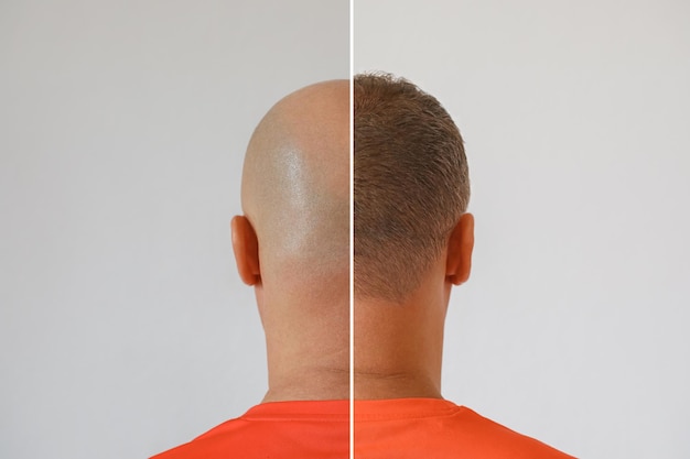 La cabeza de un hombre calvo antes y después de la cirugía de trasplante de cabello Un hombre que pierde el cabello se ha vuelto peludo Un cartel publicitario de una clínica de trasplante de cabello Tratamiento de la calvicie