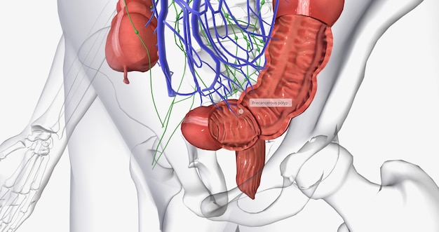 El cáncer colorrectal CRC es un cáncer de colon o recto común que afecta a muchos pacientes mayores de edad