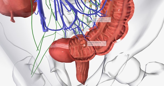Câncer colorretal O CCR é um câncer comum de cólon ou reto que afeta muitos pacientes acima da meia-idade