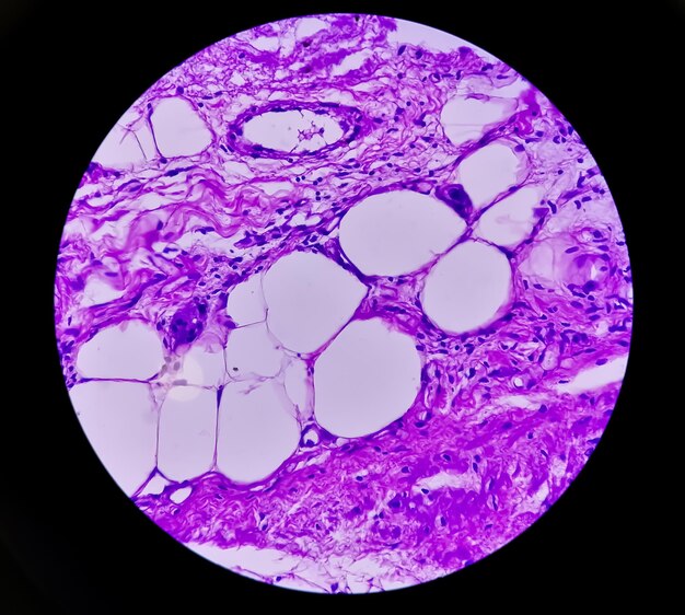 Câncer de próstata ou adenocarcinoma ou neoplasia maligna ou células epiteliais atípicas por RTU