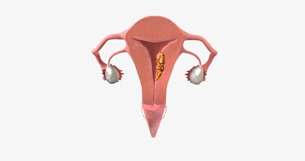 Foto el cáncer de endometrio en estadio ii se caracteriza por la diseminación del tumor al cuello uterino