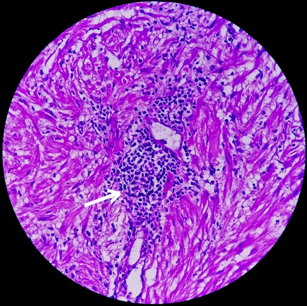 Foto cáncer de próstata o adenocarcinoma o neoplasia maligna o células epiteliales atípicas por turp