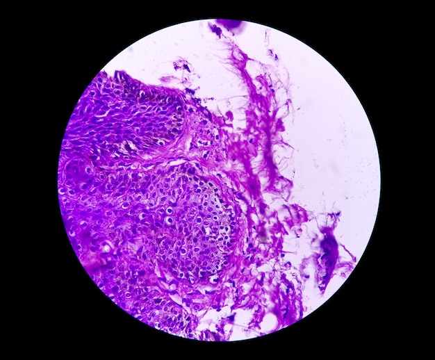 Cáncer de próstata o adenocarcinoma o neoplasia maligna o células epiteliales atípicas por TURP