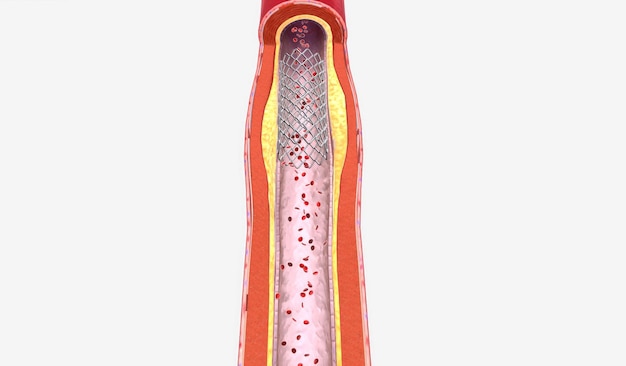 Capa de grasa acumulada en las arterias