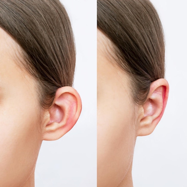Captura recortada de la cabeza de una mujer joven con orejas antes y después de la otoplastia. Resultado de corrección de aurículas.