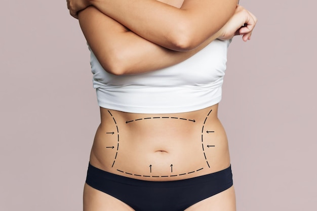 Captura recortada del cuerpo de una mujer joven con exceso de grasa con marcas en su vientre Cirugía de liposucción