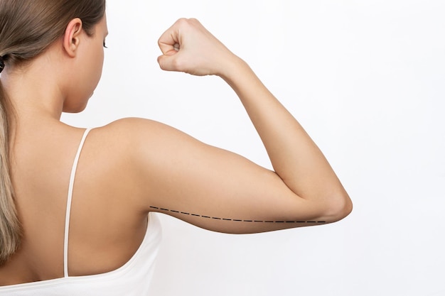 Foto captura recortada de mujer joven con exceso de grasa en la parte superior del brazo con marcas para cirugía plástica de liposucción