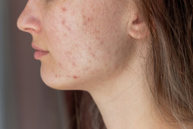 Foto captura recortada del rostro de una mujer joven de perfil con problema de acné, espinillas, cicatrices rojas en las mejillas