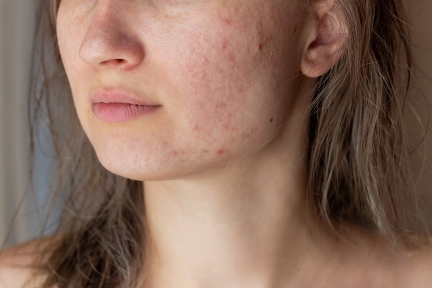 Foto captura recortada del rostro de una mujer joven con el problema del acné, espinillas, cicatrices rojas en las mejillas y el mentón