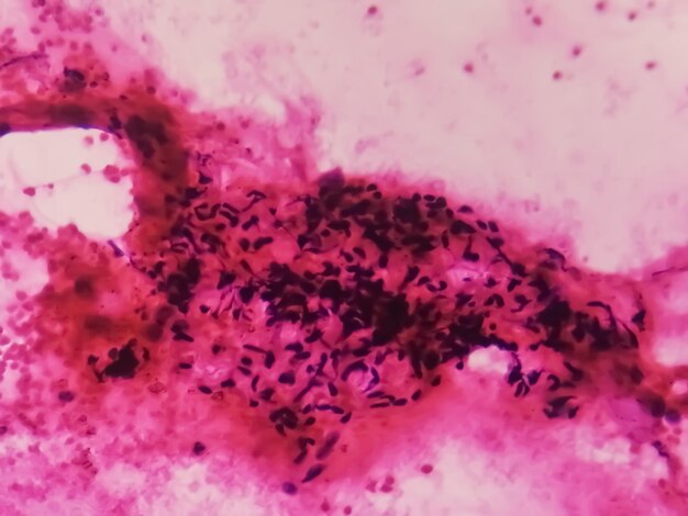 Foto carcinoma de células pequeñas bajo microscopia