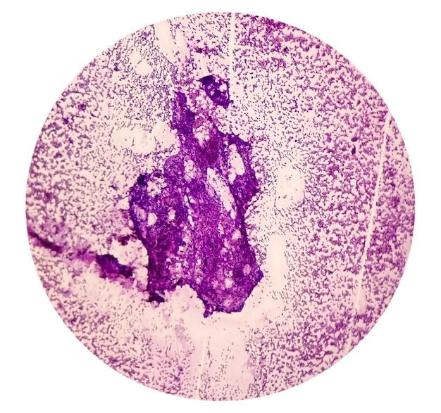 Carcinoma de células pequeñas de pulmón Imagen microscópica del departamento de citopatología