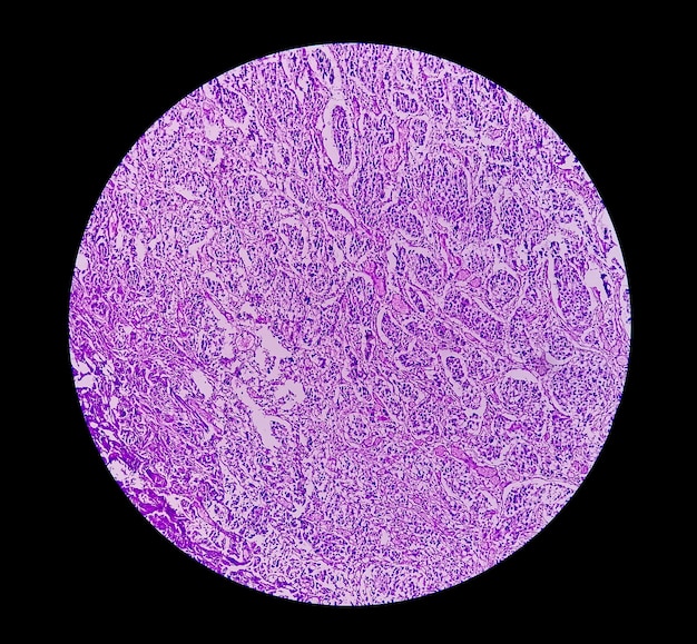 Carcinoma de células transicionales de alto grado o TCC a Cáncer de vejiga o carcinoma urotelial
