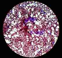Foto carcinoma de células escamosas metastático de um humano. fotomicrografia vista ao microscópio.