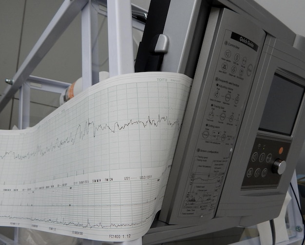 Foto cardiograph druckt die analyse der menschlichen herzfrequenz