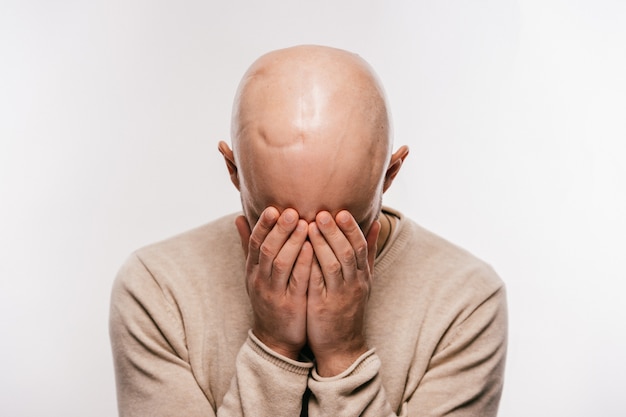 Careca com cicatriz na cabeça após operação oncológica, chorando e escondendo o rosto com as mãos.