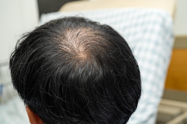 Careca no meio da cabeça e sem perda de cabelo glabro de homem de negócios asiático maduro