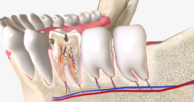 Foto cárie dentária ou cavidades são áreas de cárie dentária causadas por bactérias produtoras de ácido na boca