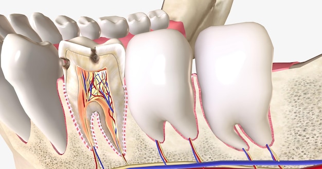 Las caries o caries dentales son áreas de caries causadas por bacterias productoras de ácido en la boca.