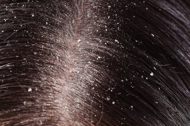 Caspa en el cabello oscuro de la mujer.