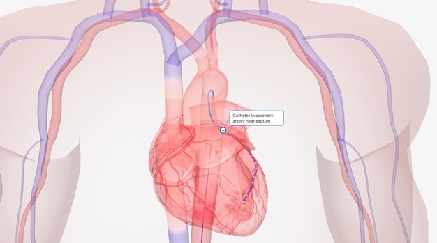 Catéter en arteria coronaria cerca del tabique