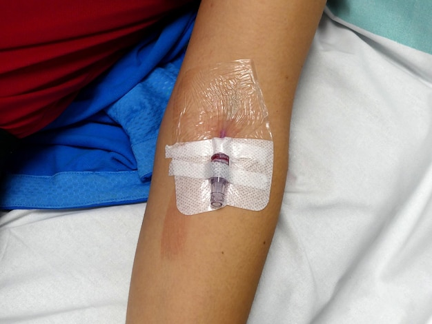 Catéter venoso periférico moderno para infusión intravenosa en el brazo femenino en el hospital