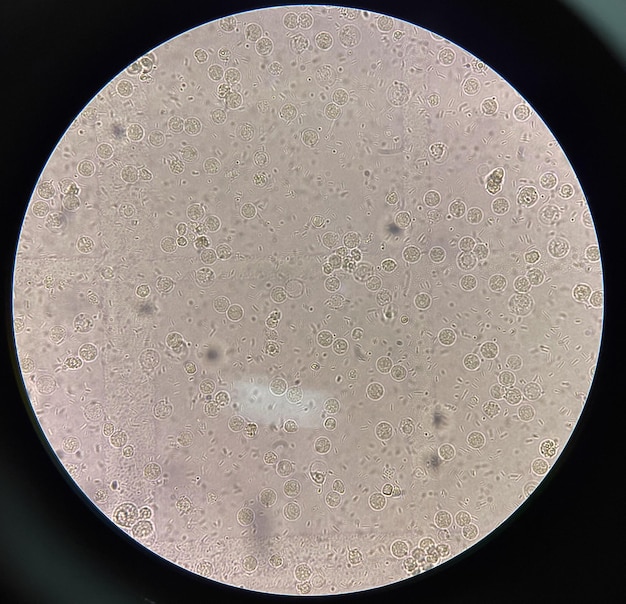 Foto célula bacteriana fresca en la muestra de orina