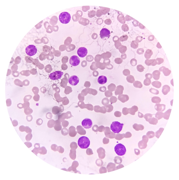 Foto células de leucemia mieloide aguda (lma) analisadas por microscópio de luz. micrografia com zoom de 200x