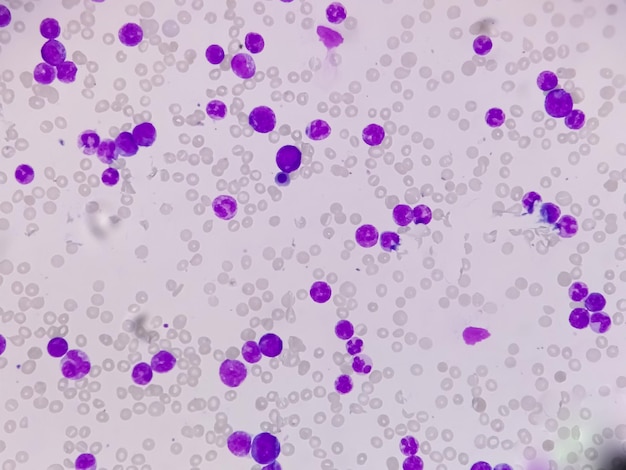 Foto células de leucemia mieloide crónica o cml, analizadas por microscopio óptico. ampliación original 400x